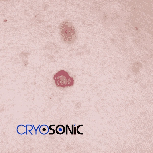 Looking for pain free cherry angioma removal treatment Stevenage? Call our team today! Stevenage