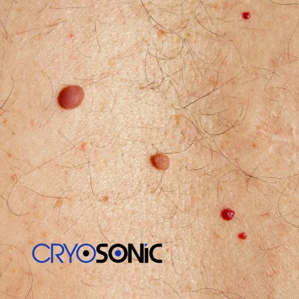 get cherry angioma removal treatment today! Stevenage