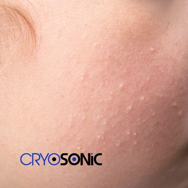 Are you looking for milia removal treatment? Contact our team today Stevenage