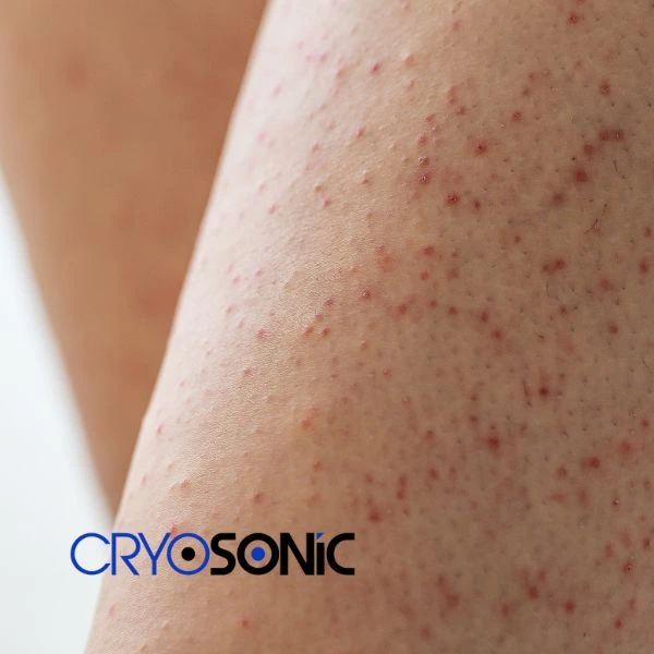 Looking for Seborrhoeic Keratosis removal Stevenage treatment? Call our consultants today in Stevenage
