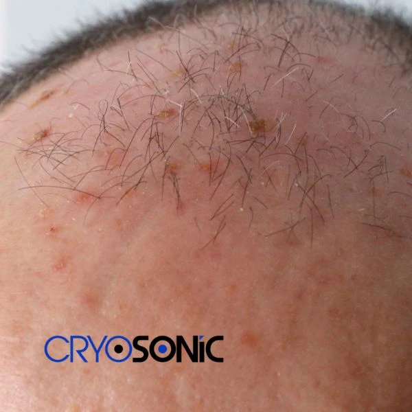 Access Seborrhoeic Keratosis removal from the comfort of your own home! Call us today in Stevenage