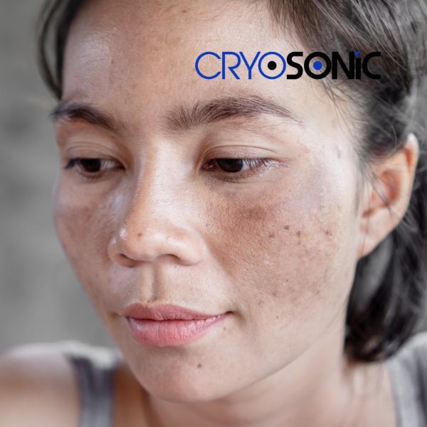 Ready to start age spots removal? Contact our team today in Stevenage