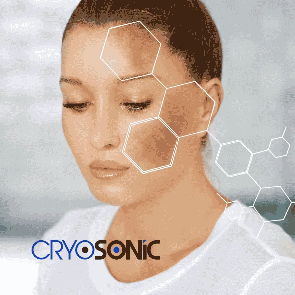 Are you looking for age spot removal treatment? Contact Cryosonic today in Stevenage
