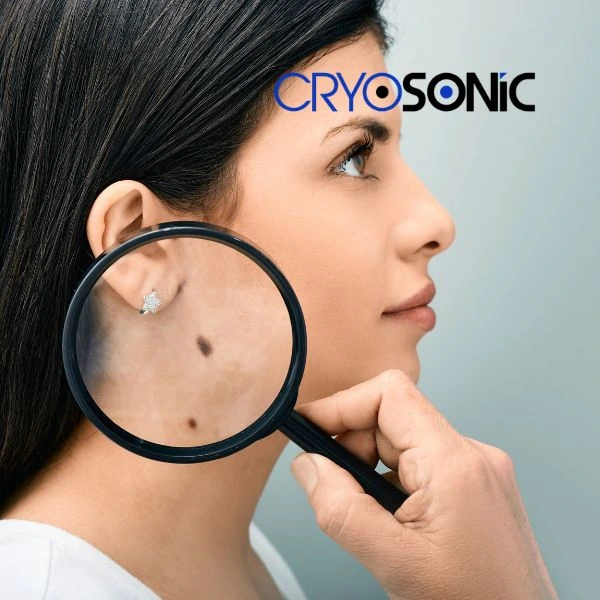 Do you want to learn more about benign moles removal treatment? Call our team today Stevenage