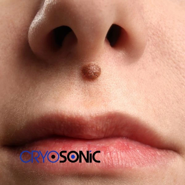 Start your benign moles removal treatment today Stevenage