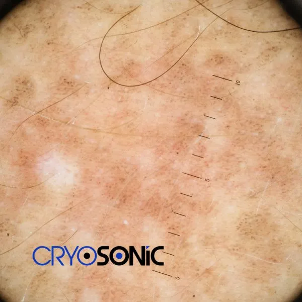Speak to our team today about sun damaged skin treatment today in Stevenage