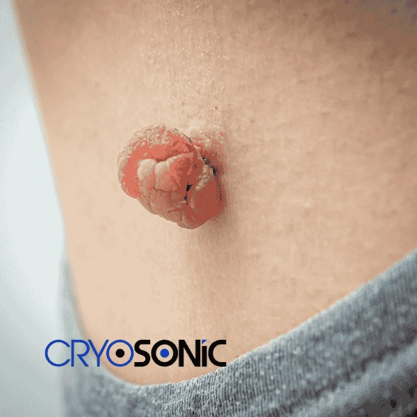 Book your skin tags removal Stevenage from comfort of your own home! Stevenage