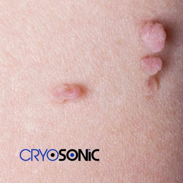 Are you looking for fast effect skin tag removal Stevenage? Book in NOW! Stevenage