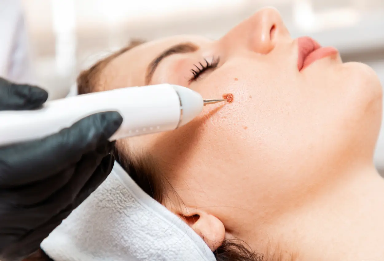 Frequently Asked Questions About Multiple Cryotherapy Treatments Stevenage