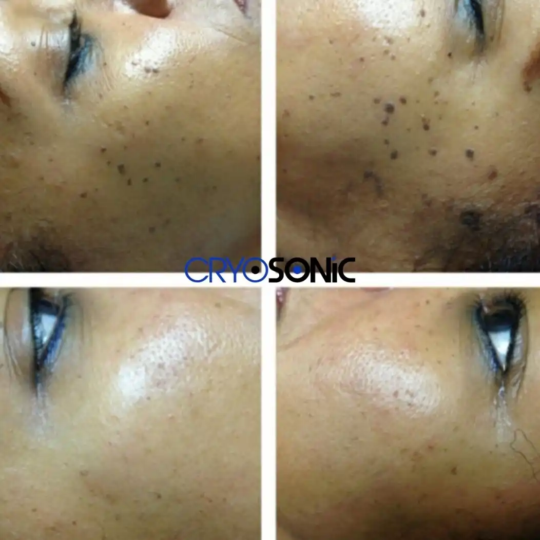 Why Skin Shows Pigmentation After Treatment Stevenage