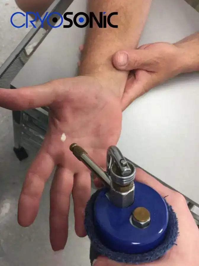 Temperature Differences: OTC vs Medical-Grade Cryotherapy Stevenage